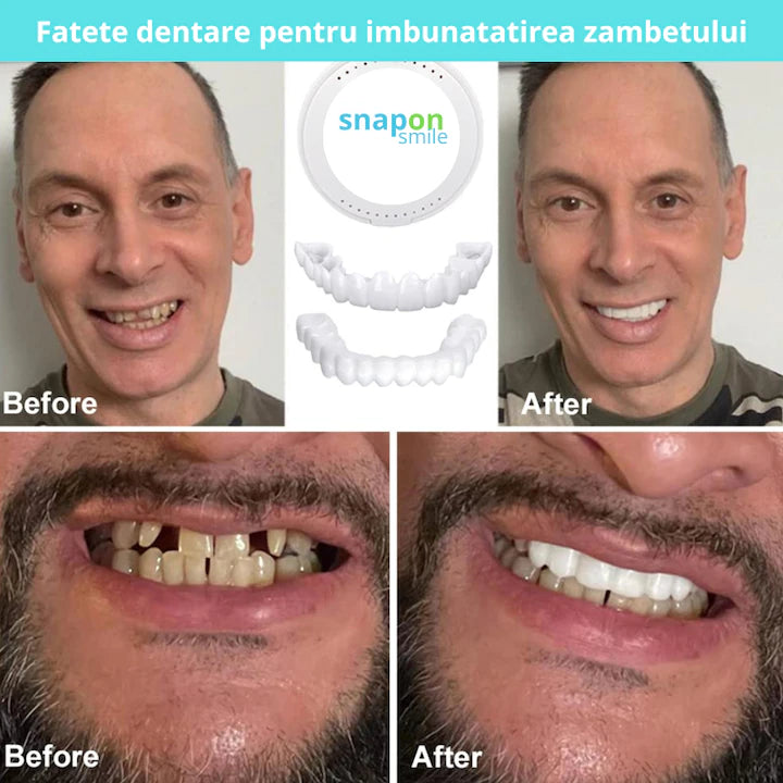 Snap On Smile - Snap On Smile
